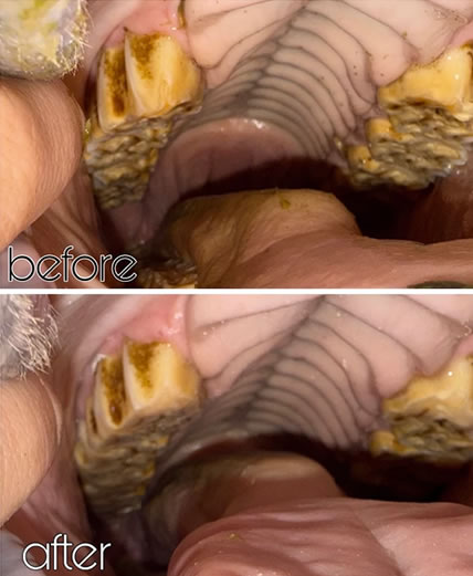 gingivitis